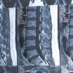 椎間板ヘルニア ・脊柱管狭窄症